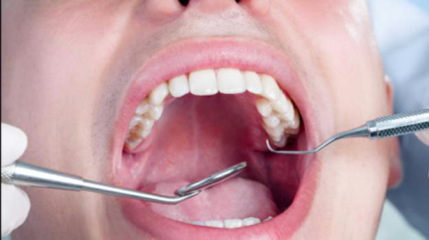 Dente Siso: 7 mitos e verdades