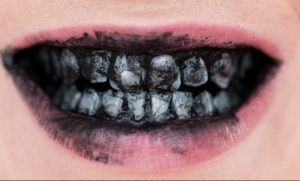 Carvão para os dentes: nem tudo é o que parece ser