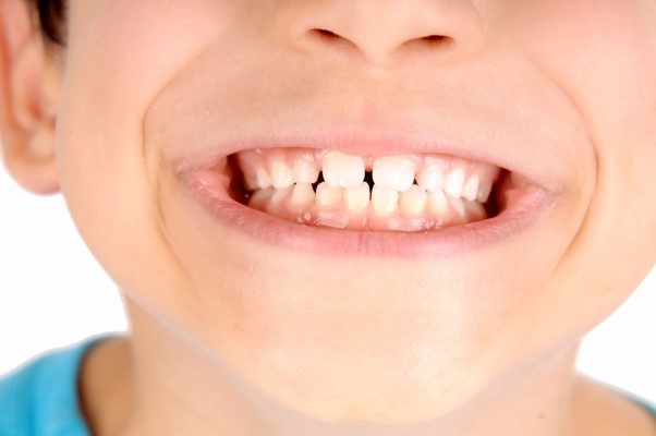 Manchas brancas nos dentes dos seus filhos? Não se desespere!