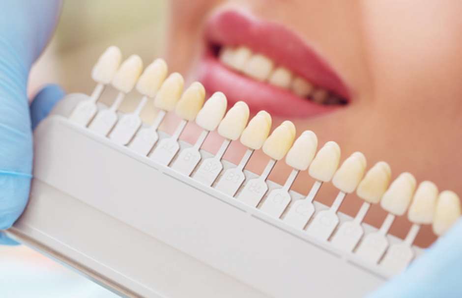 Lentes de contato dental x faceta de resina: quais as diferenças?