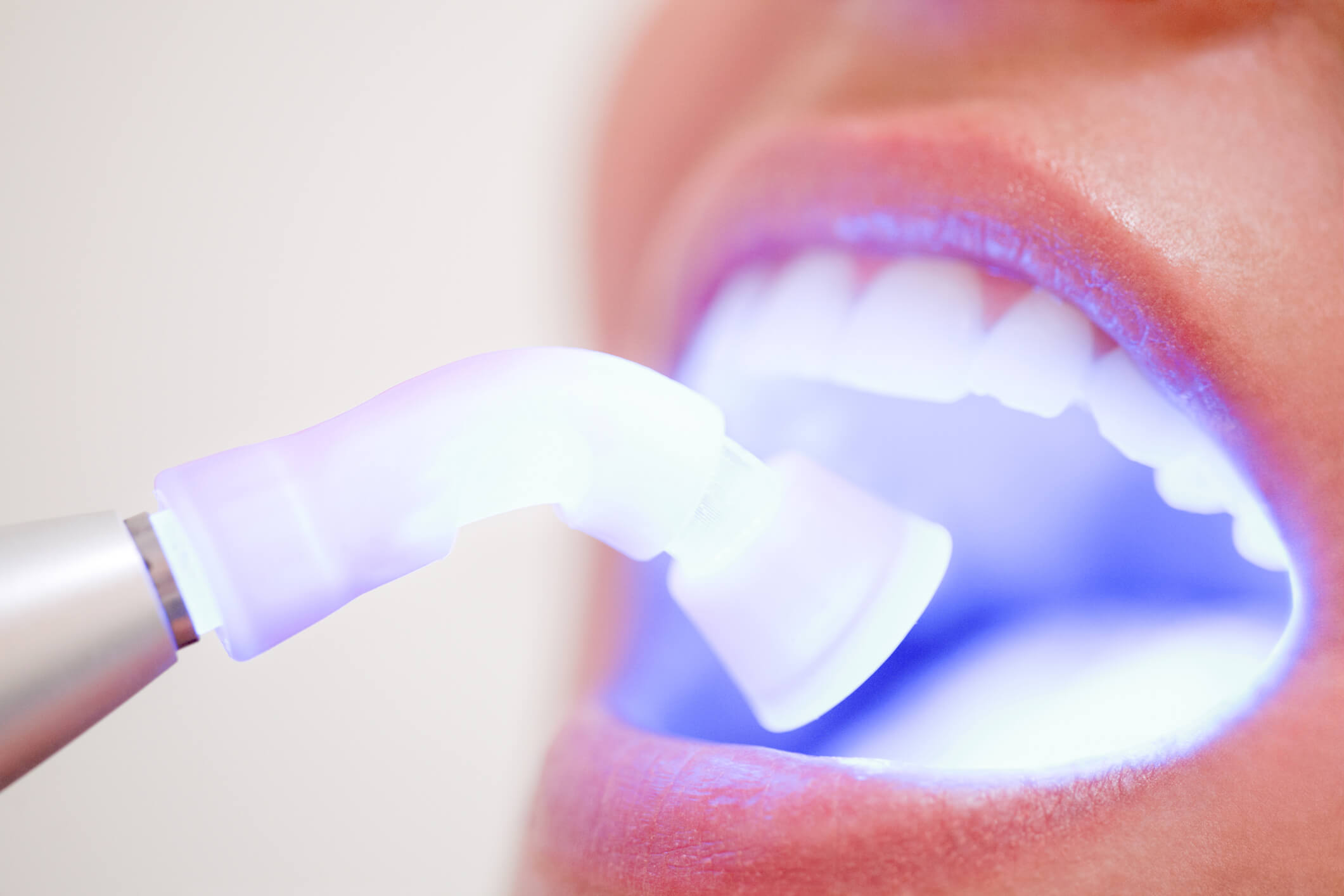 Clareamento dental para fluorose dentária