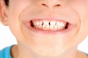 Manchas brancas nos dentes: como surge e como tratar a fluorose dentária