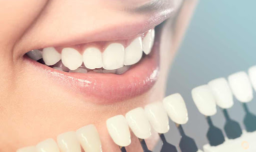 A faceta dental pode substituir o aparelho ortodôntico?