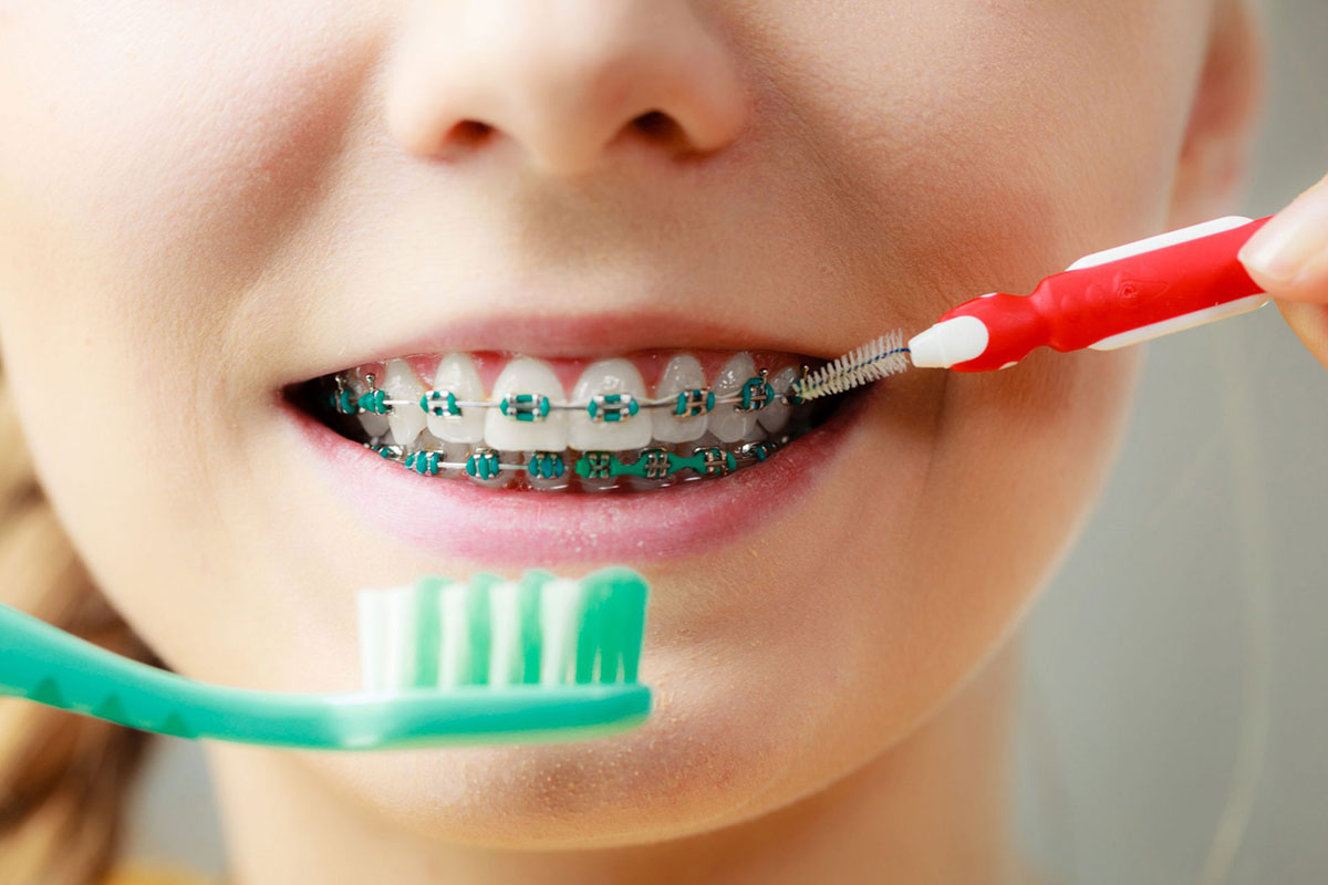 Uma criança com aparelho ortodôntico sorri. Na sua frente estão duas escovas de dentes. 