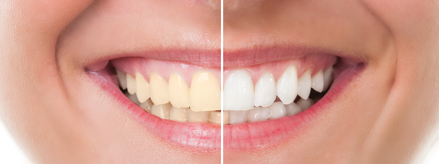 Clareamento dental: Saiba a diferença entre o caseiro e o de consultório
