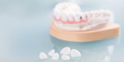 lente-de-contato-dental-desvantagens-post-blog lente-de-contato-dental-desvantagens-post-blog